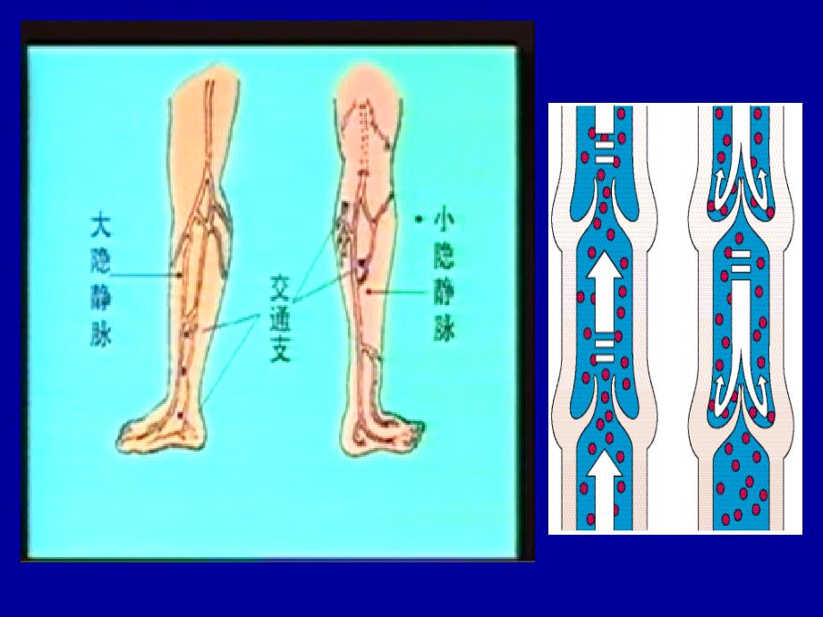 静脉系统常见疾病_第3页