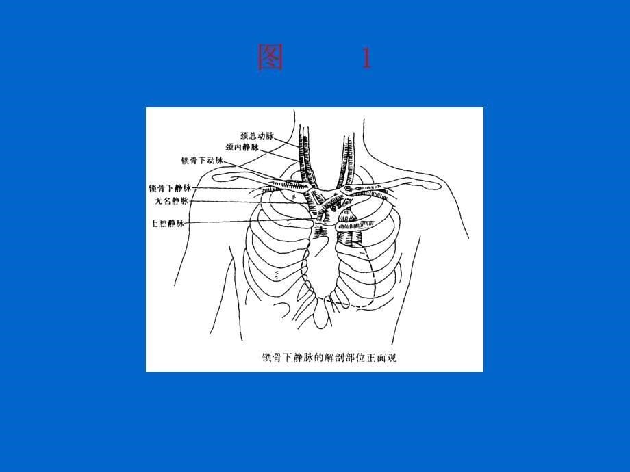 锁骨下静脉穿刺置管术_第5页