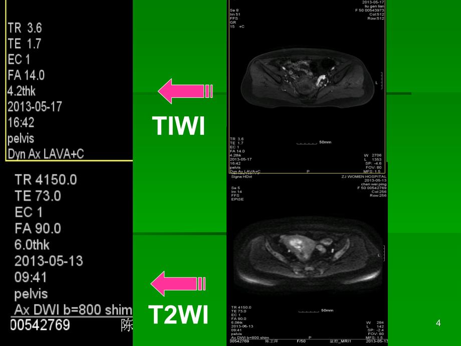 女性盆腔疾病MRI诊断特点(多图)永久珍藏ppt课件_第4页