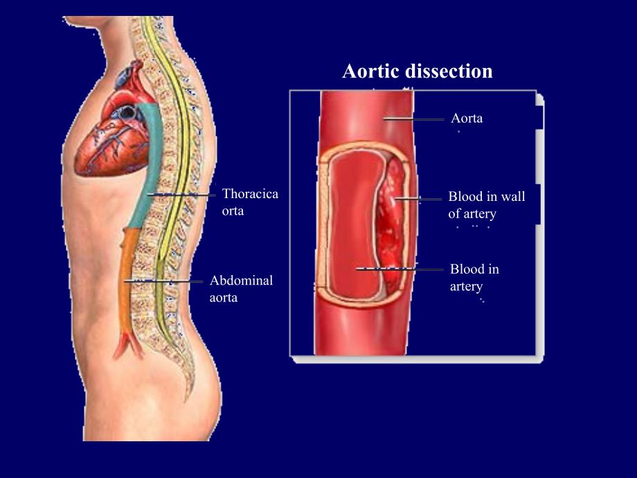 主动脉夹层的分型、影像诊断及治疗_第4页