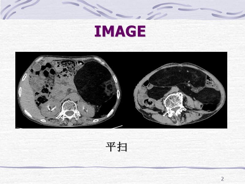 脂肪肉瘤一例CT表现-文档资料_第2页