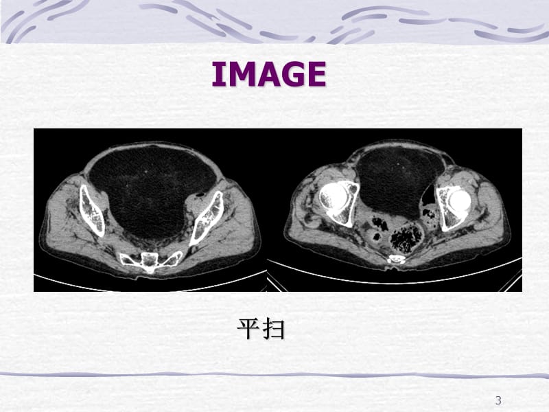 脂肪肉瘤一例CT表现-文档资料_第3页