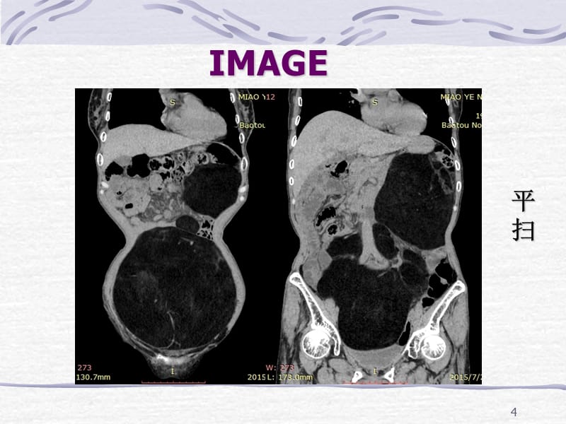 脂肪肉瘤一例CT表现-文档资料_第4页