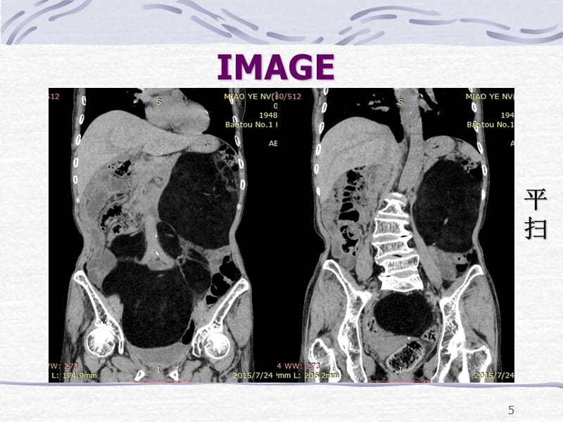 脂肪肉瘤一例CT表现-文档资料_第5页