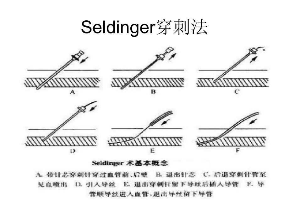 脑血管造影指南解读教学课件_第4页