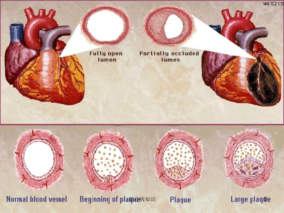 冠心病病人的护理（专业应用）_第5页