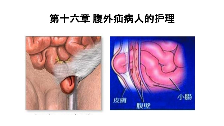 腹外疝病人的护理精品_第1页