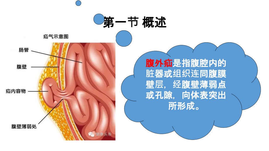 腹外疝病人的护理精品_第4页