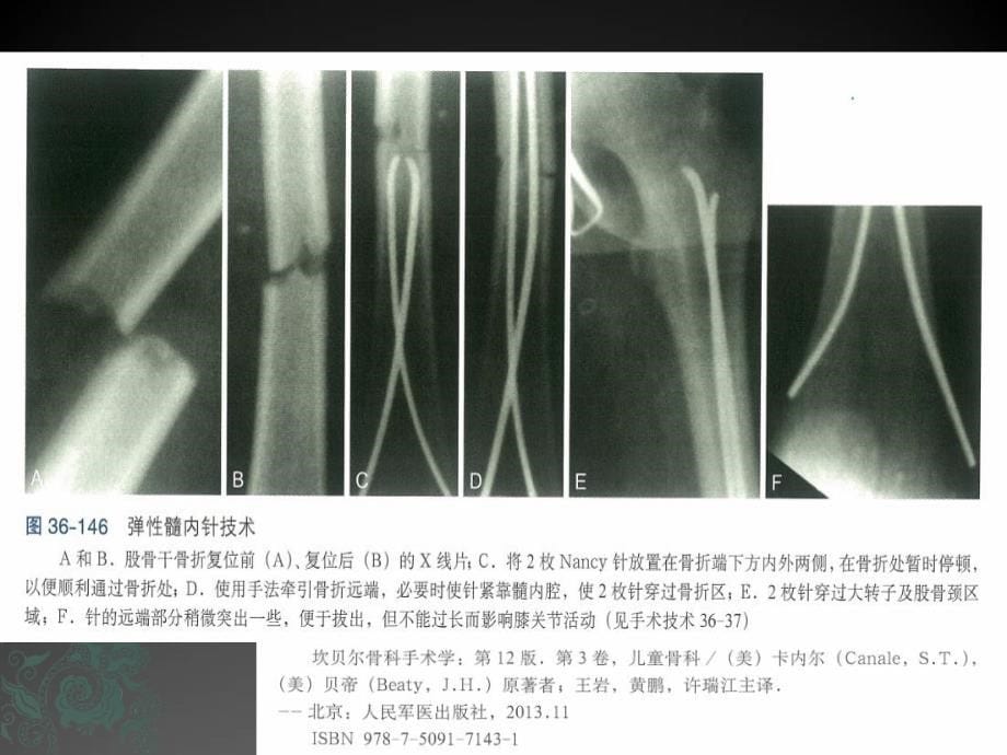 （推荐精选）儿童长骨骨折弹性髓内钉_第5页