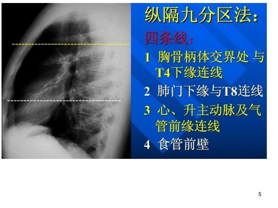 （推荐精选）胸部CT影像示意图_第5页