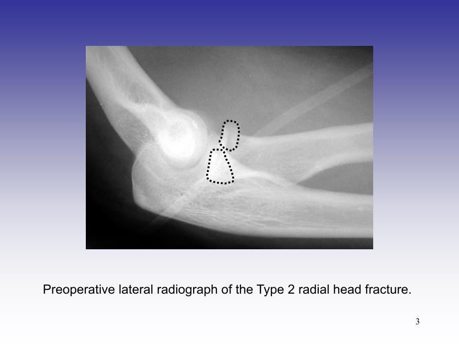 （推荐精选）桡骨小头骨折切开内固定术_第3页