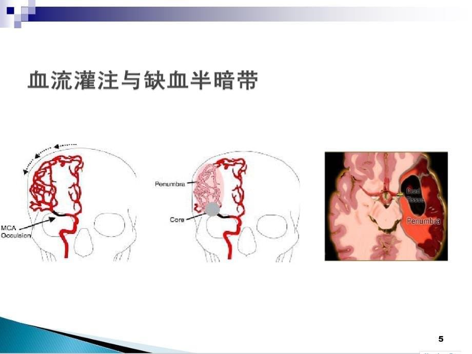 （推荐精选）急性缺血性脑卒中的静脉溶栓_第5页