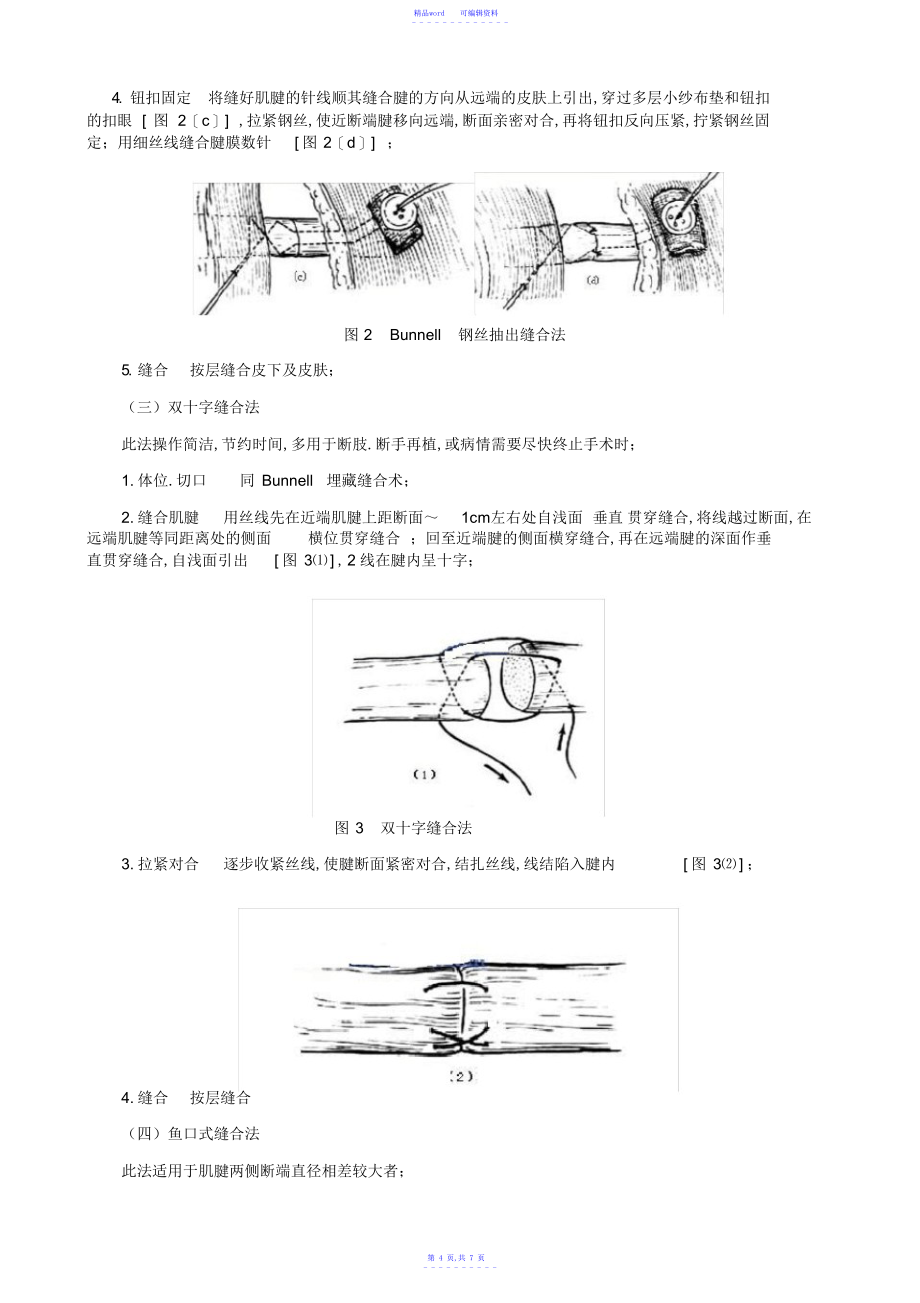 2021年肌腱缝合方法_第4页