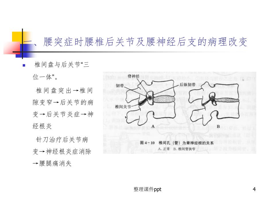 《腰椎病针刀治疗》PPT课件_第4页