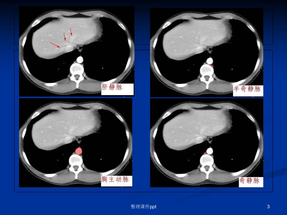 《腹部CT解剖》PPT课件_第3页