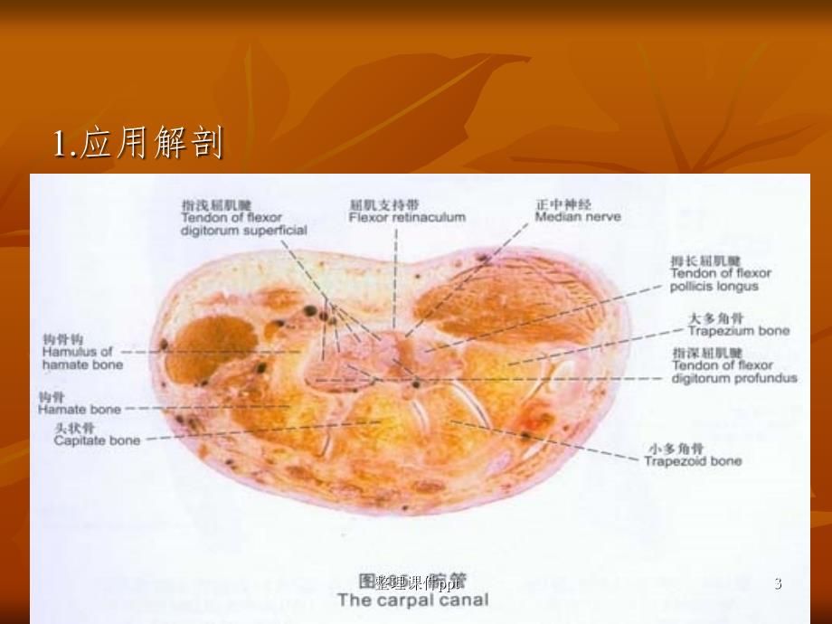 《腕管综合症》PPT课件_第3页