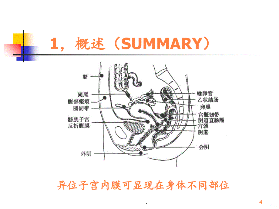 2021年妇产科内膜异位症子宫腺肌异位症ppt课件_第4页