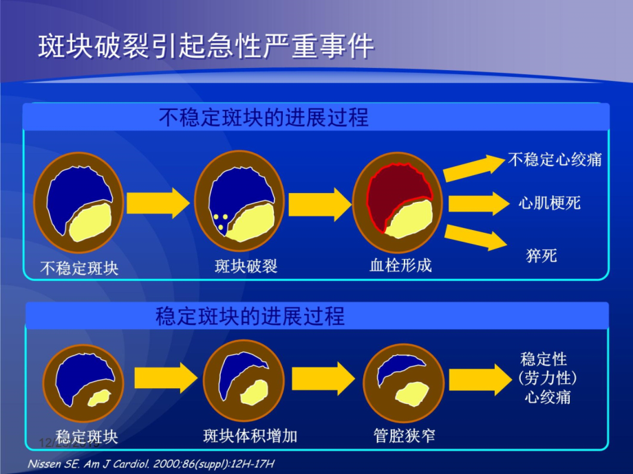 冠心病review教学文稿_第4页