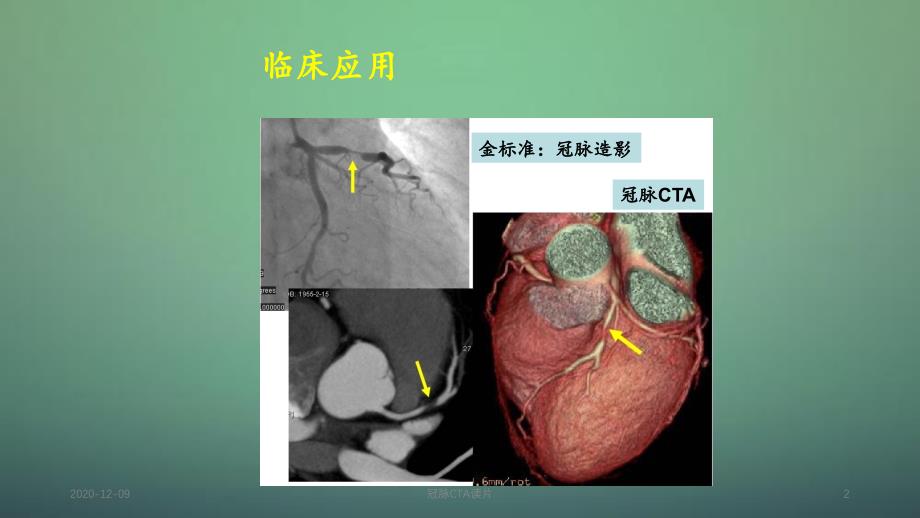 冠脉CTA读片_第2页