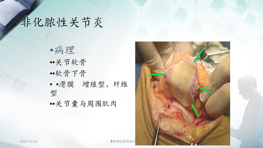 骨科非化脓性关炎（PPT课件）_第5页