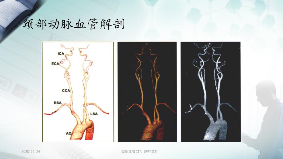 颈部血管CTA（PPT课件）_第4页