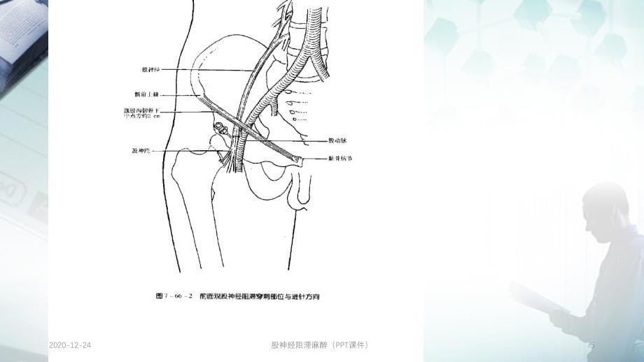 股神经阻滞麻醉（PPT课件）_第5页