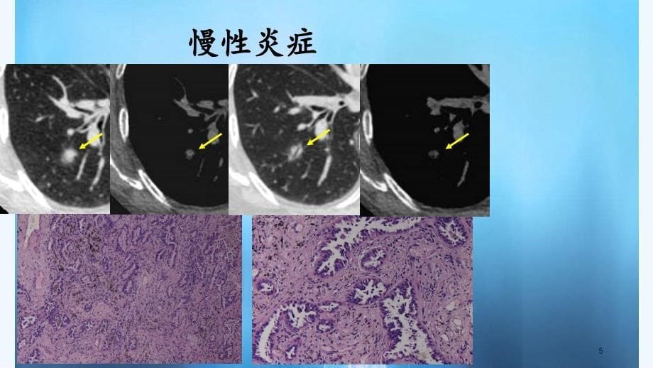 肺磨玻璃结的CT诊断与随访（PPT课件）_第5页