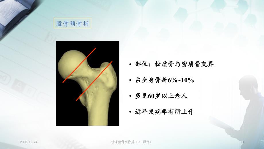 讲课股骨颈骨折（PPT课件）_第3页