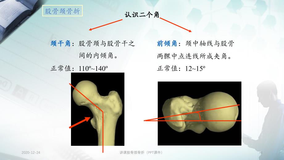 讲课股骨颈骨折（PPT课件）_第4页