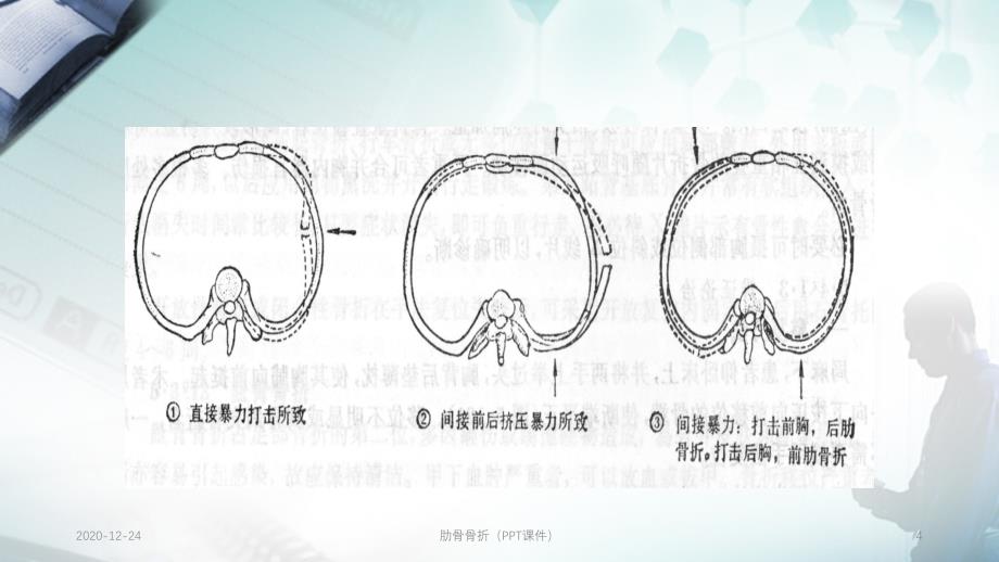 肋骨骨折（PPT课件）_第4页