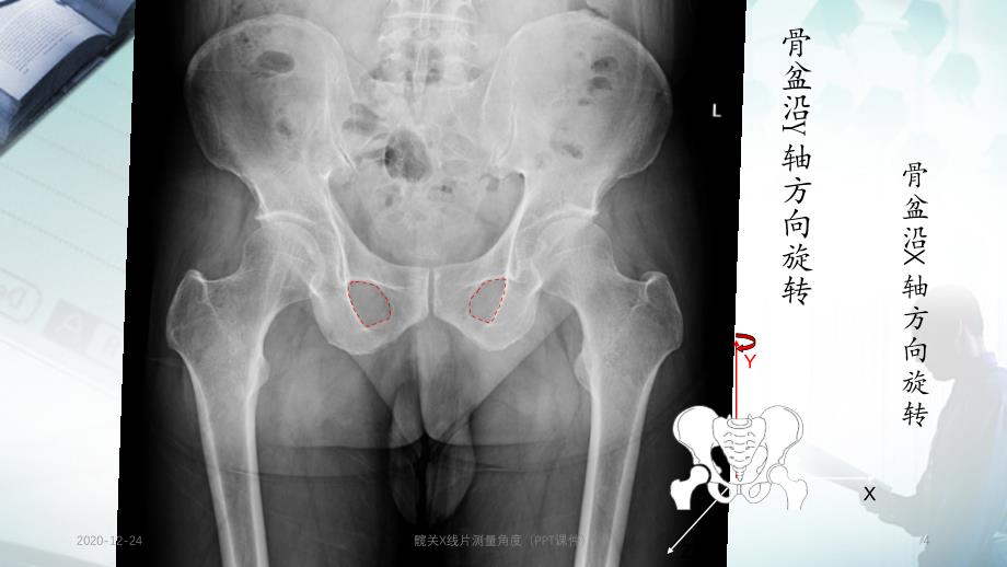 髋关X线片测量角度（PPT课件）_第4页