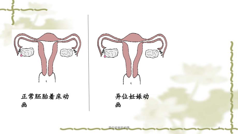 异位妊娠的护理（实用课件）_第4页