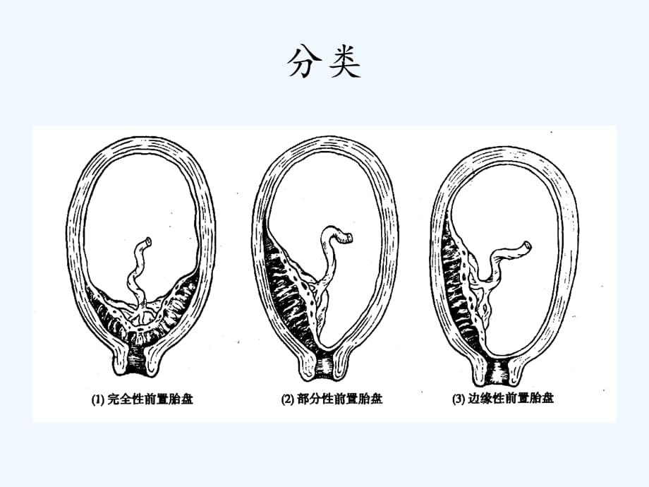 前置胎盘护理（实用干货）_第3页