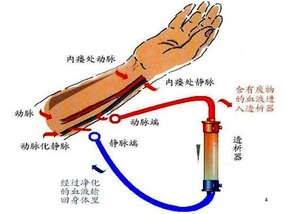 动静脉内瘘的围手术期护理（实用干货）_第4页