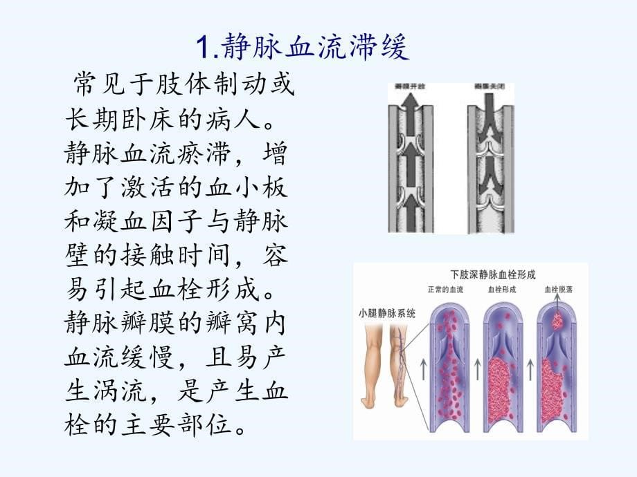 下肢深静脉血栓的预防与护理（实用干货）_第5页