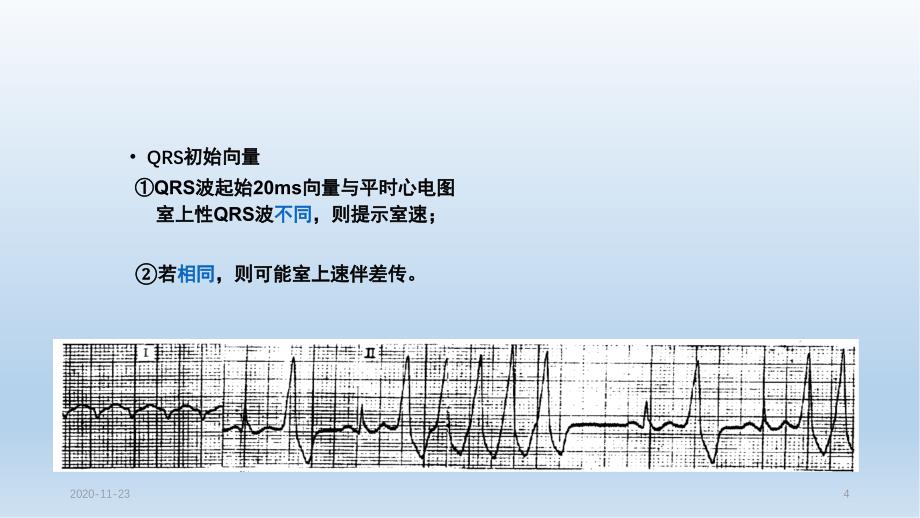 室速的诊断与鉴别诊断（实用课件）_第4页