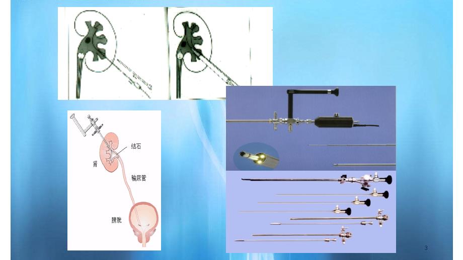 经皮肾镜手术解_第3页