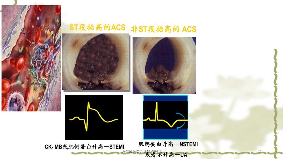 急性冠脉综合征的护理[1]（实用课件）_第4页