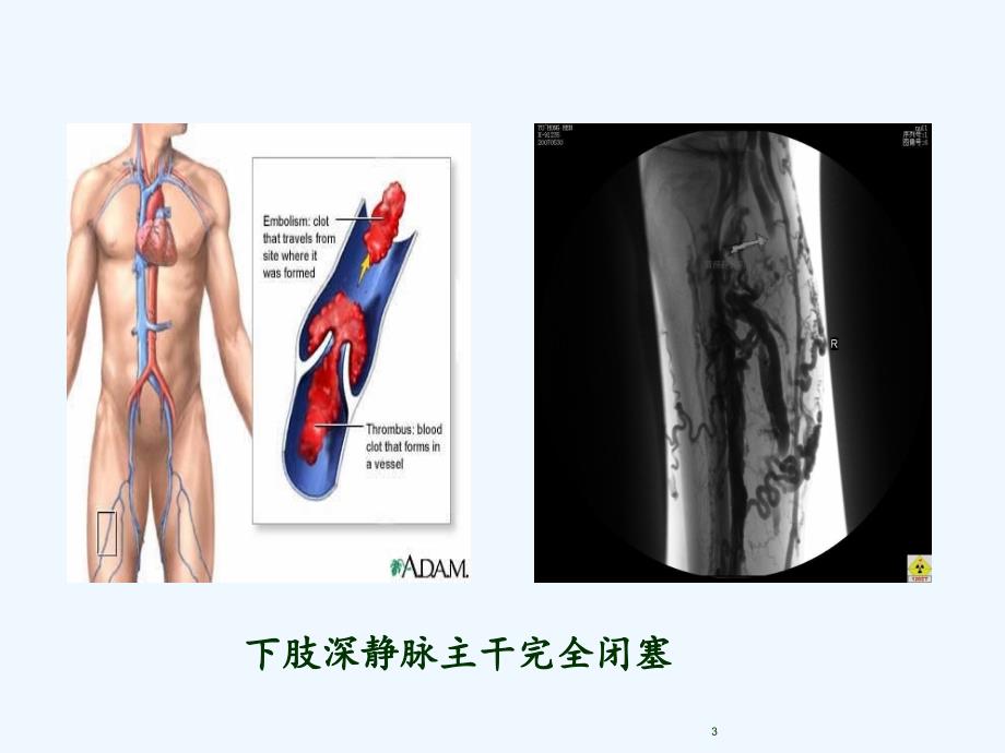 下肢深静脉血栓的护理（实用干货）_第3页