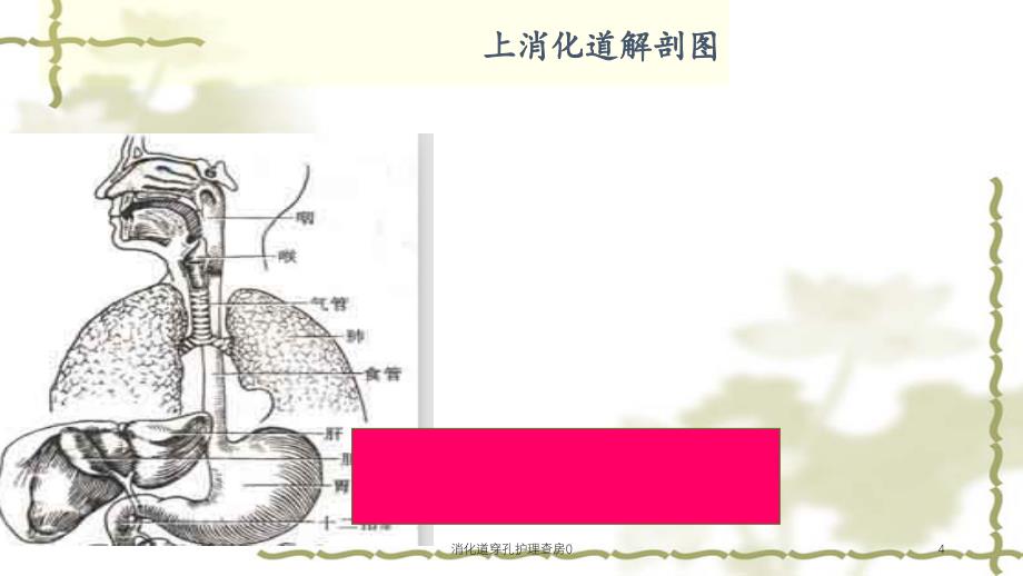 消化道穿孔护理查房0（实用课件）_第4页