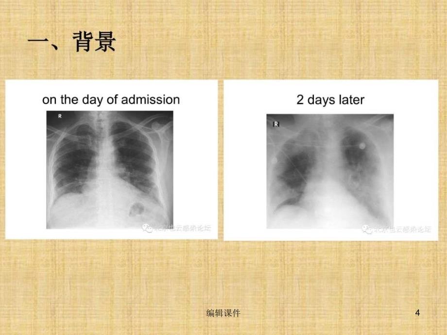 《中东呼吸综合征》_第4页