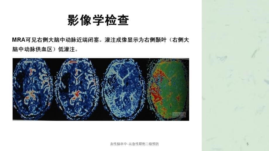 血性脑卒中-从急性期到二级预防课件_第5页