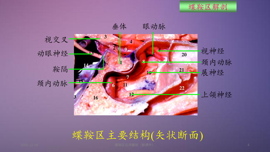 蝶鞍区应用解剖（精品收藏）_第4页