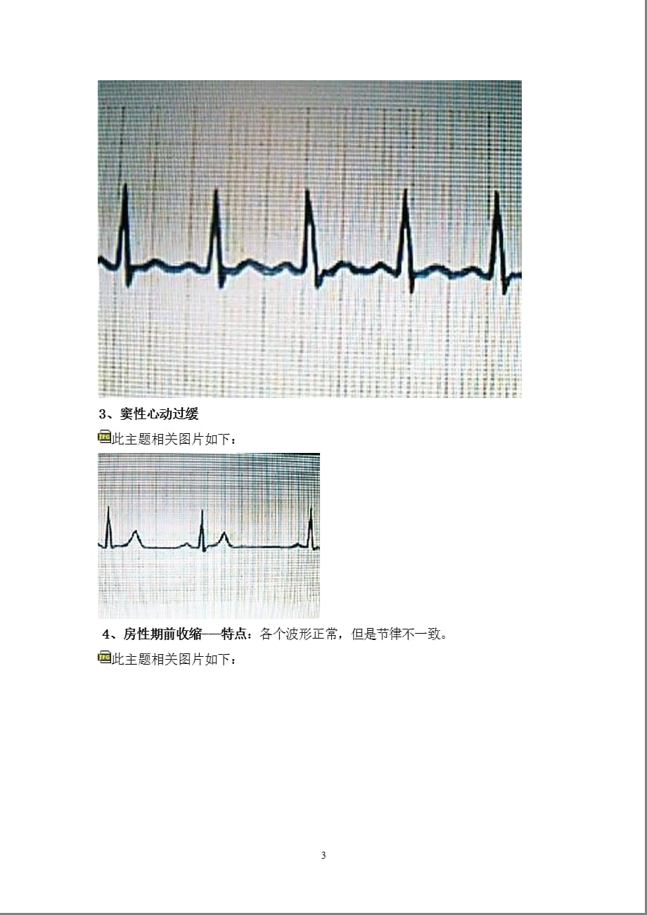 典型心电图讲解（2021年整理）_第3页