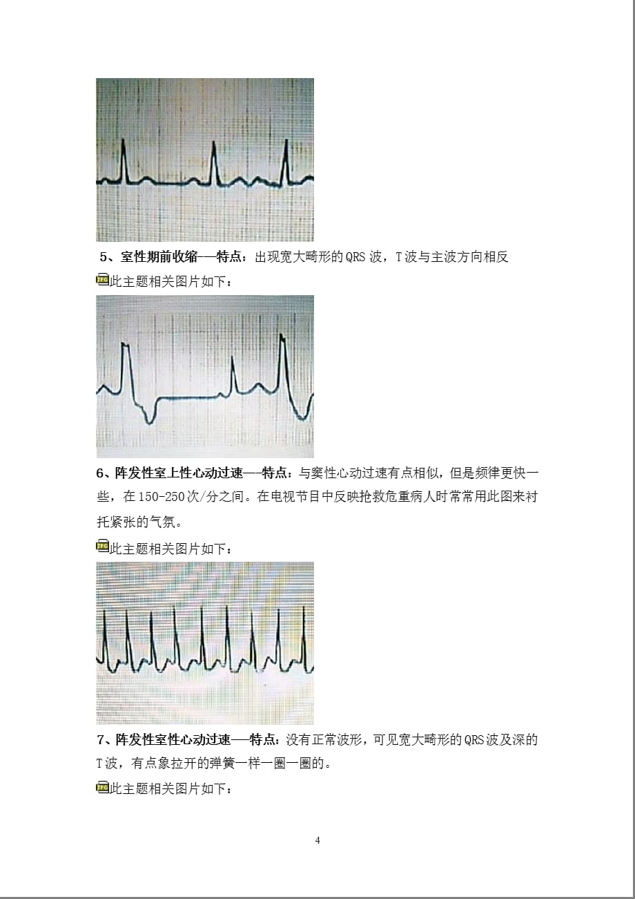 典型心电图讲解（2021年整理）_第4页