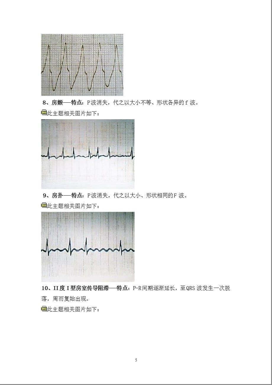 典型心电图讲解（2021年整理）_第5页