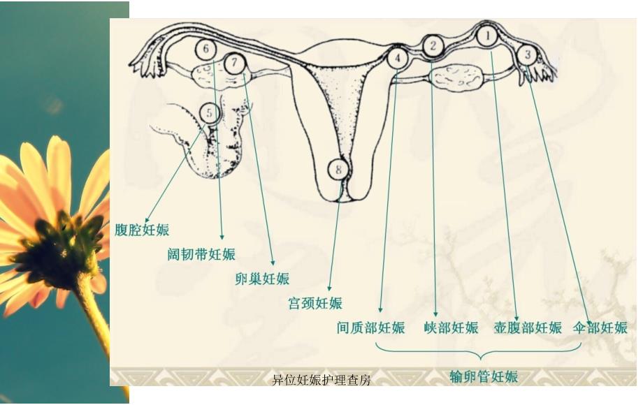 异位妊娠护理查房（经典实用）_第4页