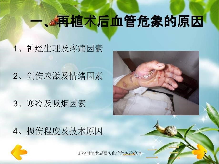 断指再植术后预防血管危象的护理课件_第5页