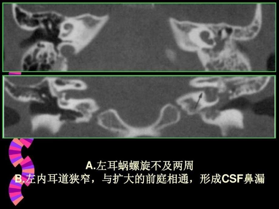 内耳畸形CT表现ppt课件[精选]_第5页