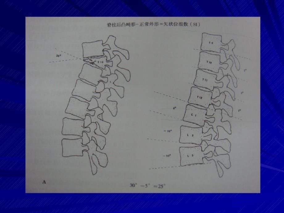 刘理迪腰椎X线测量ppt课件[精选]_第5页